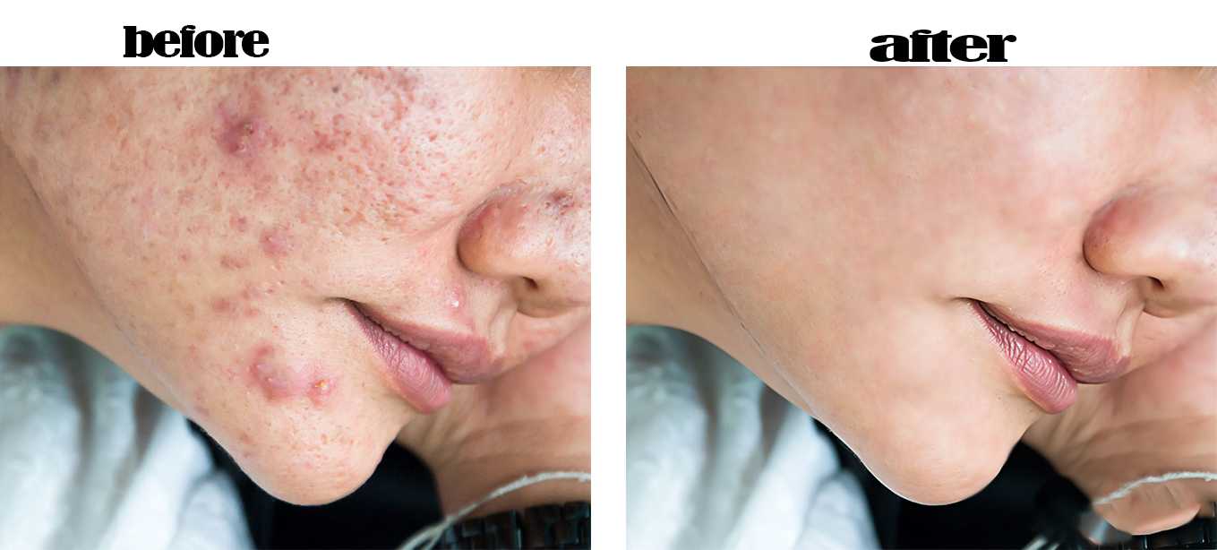 Skin Retouching